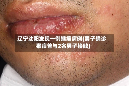 辽宁沈阳发现一例猴痘病例(男子确诊猴痘曾与2名男子接触)-第2张图片